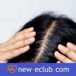 Bumser på hovedet - hvad er årsagerne og behandlingerne? Krosty na głowie